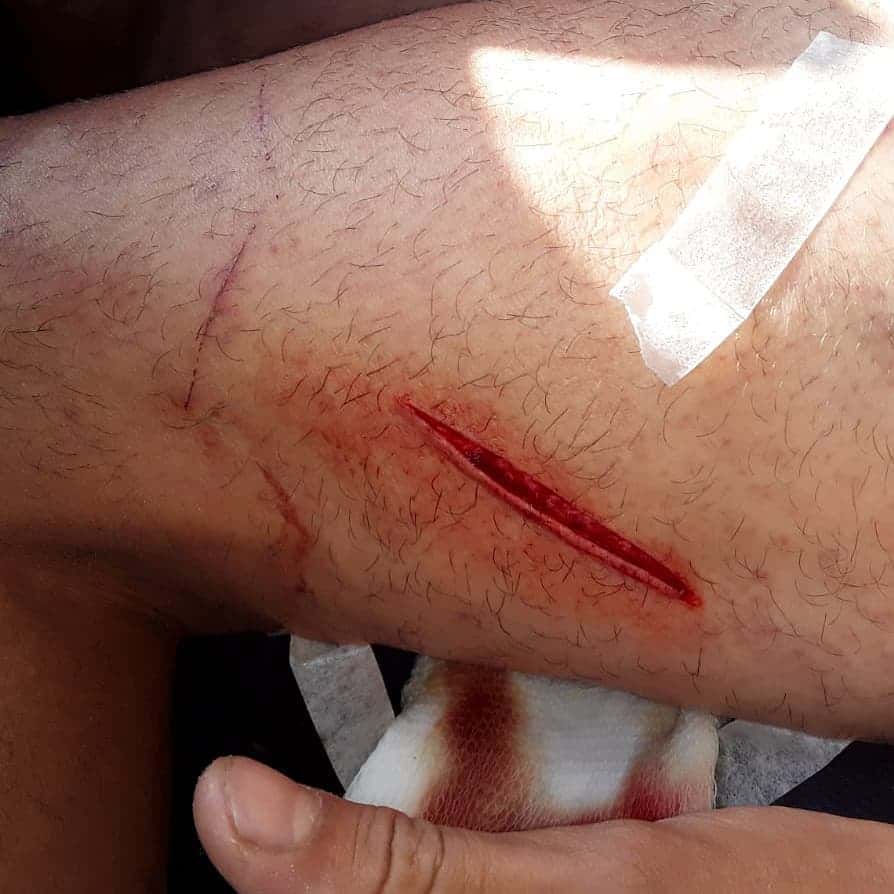 Ocho puntos de sutura para otro recolector que se cortó con un vidrio roto