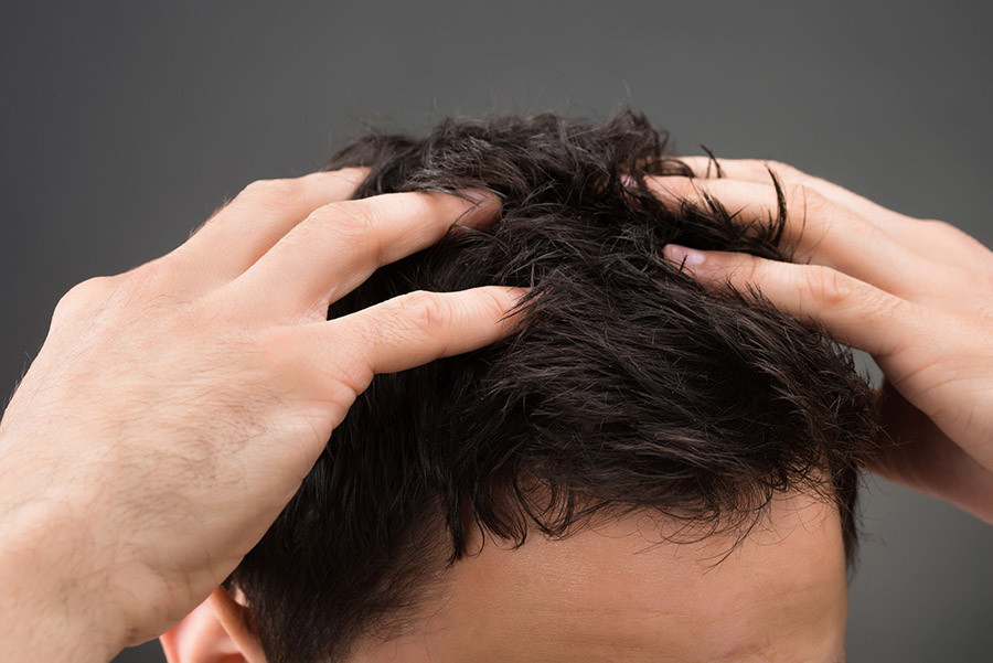 caída de pelo