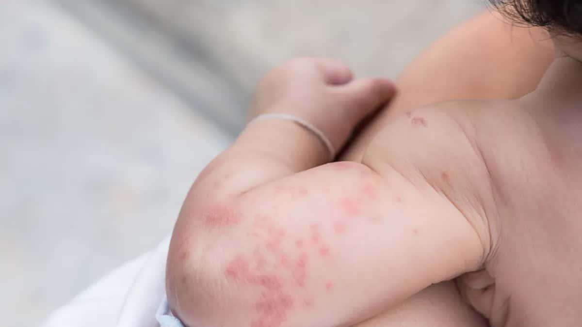 Alergias en los bebés