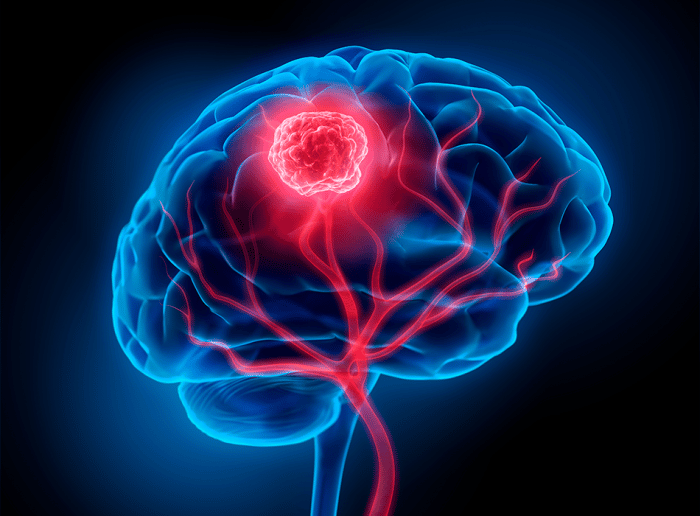 Descubren que los tumores cerebrales hackean la comunicación entre neuronas