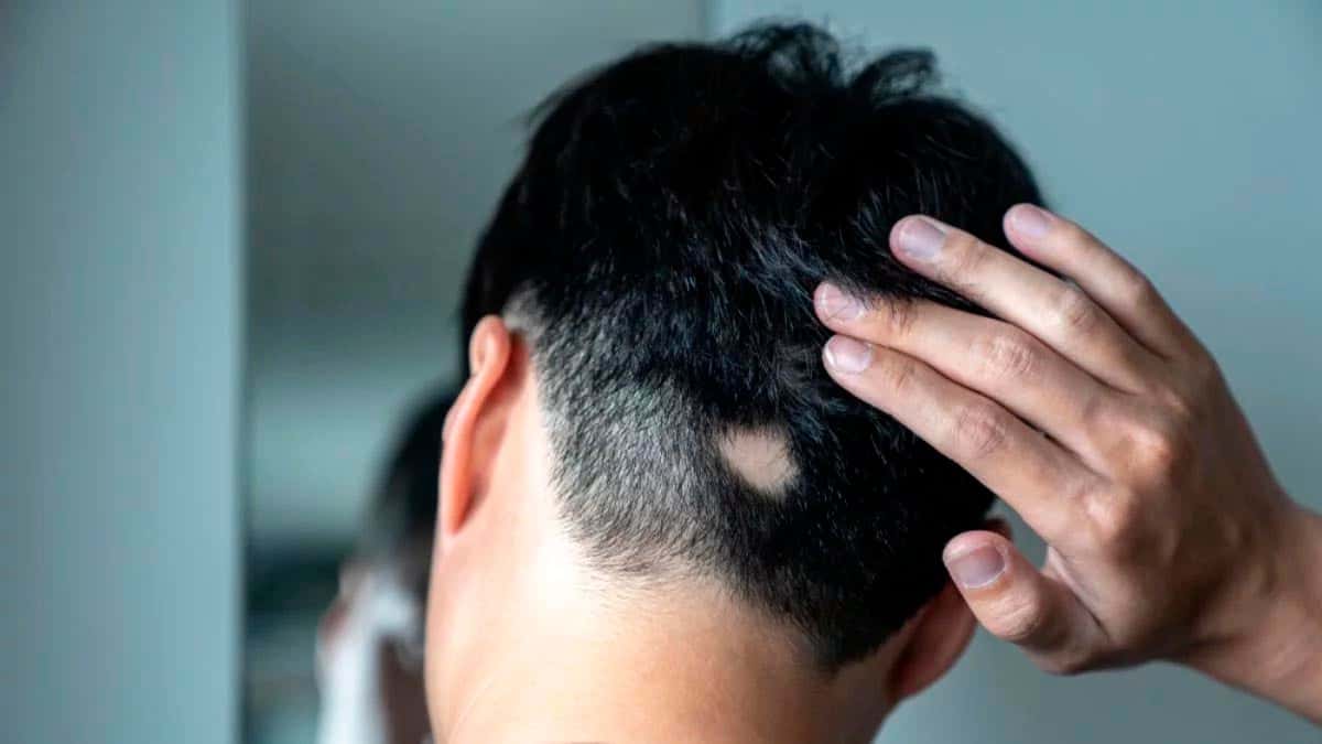 Romper estigmas en el mundo de la alopecia