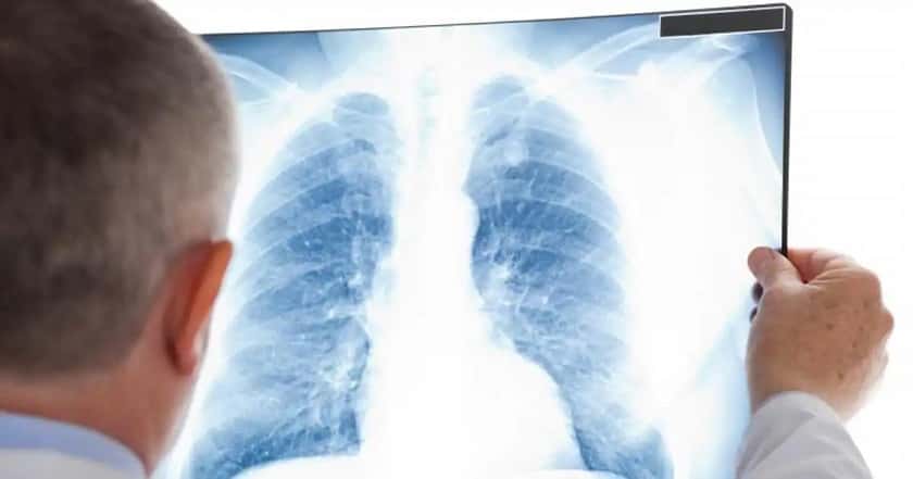 Se registra un aumento de casos de cáncer de pulmón en mujeres.
